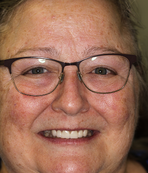 Patient 13 smile after treatment, Always About Smiles