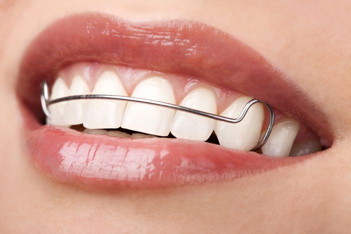 Retainers — Ventura, CA — Surfside Dental