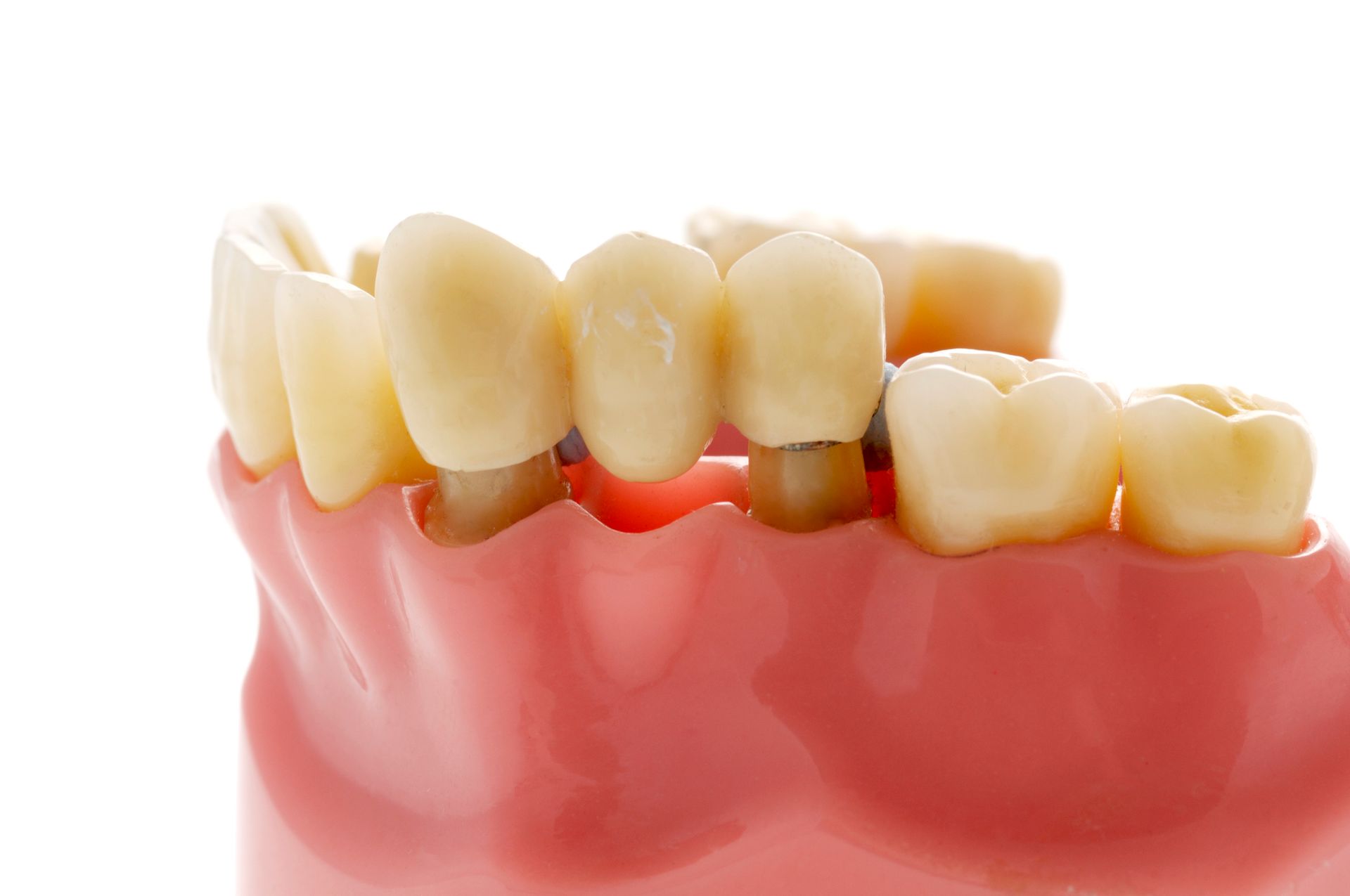 Teeth Fitting — Ventura, CA — Surfside Dental