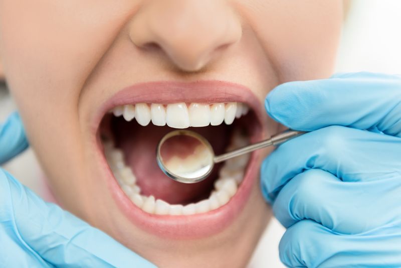 Clean Teeth — Ventura, CA — Surfside Dental