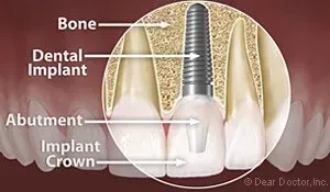 Dental Implant — Homer, AK — Preventive Dentistry Services Dental Implant — Homer, AK — Preventive Dentistry Services