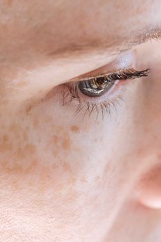 Hyperpigmentation