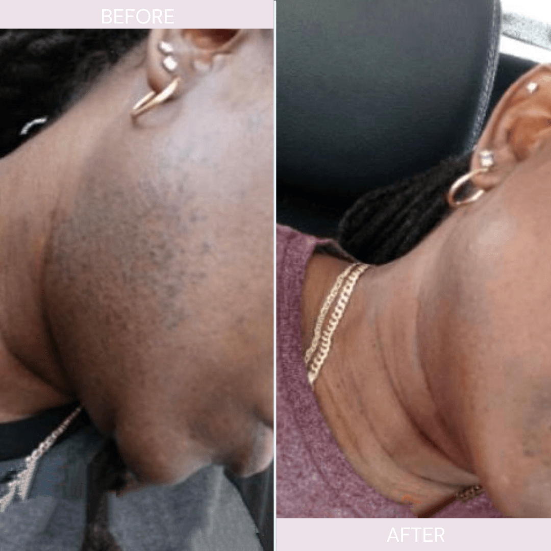 Laser hair removal on dark Skin , laser chin