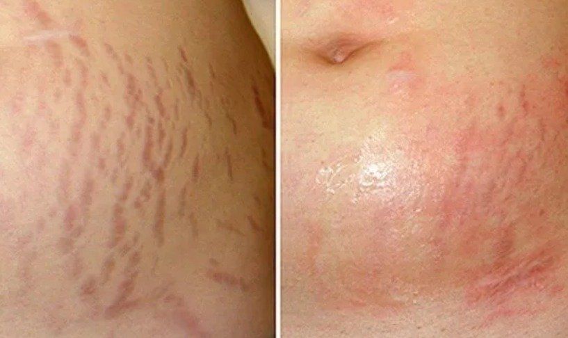 Stretch Mark Treatment Microneedle Stretch Marks Microneddle treatment
