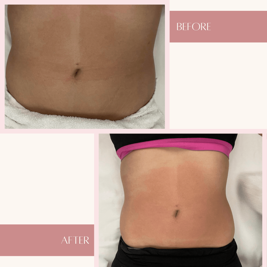 Body Sculpting Before & After at MaxAesthetics