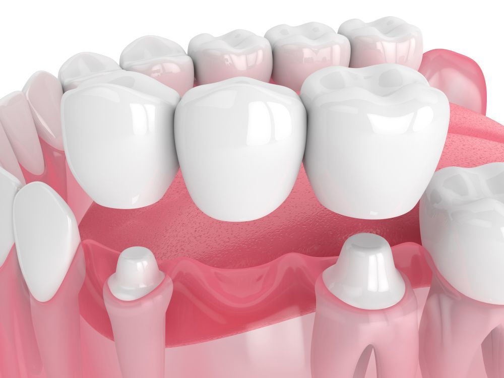 Image Of A Dental Bridge Between Two Teeth — Dentist On Tweed in Tweed Heads, NSW
