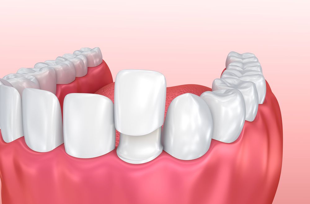 Close Up Of A Tooth With A Dental Crown On It — Dentist On Tweed in Tweed Heads, NSW