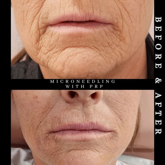 A before and after photo of a woman 's face