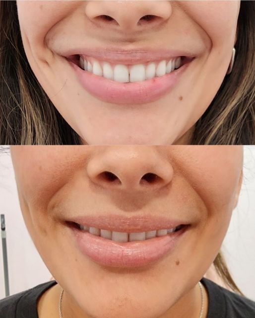 A before and after picture of a woman 's smile