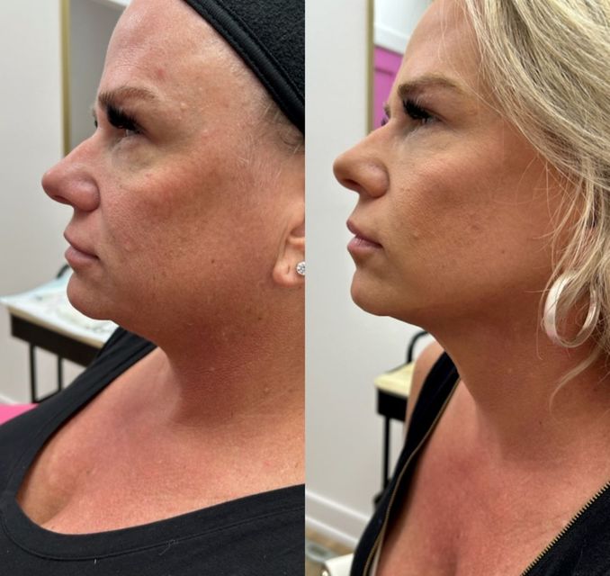 A before and after photo of a woman 's face