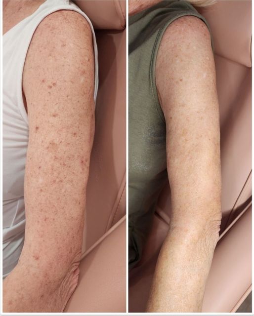 A before and after photo of a woman 's arm