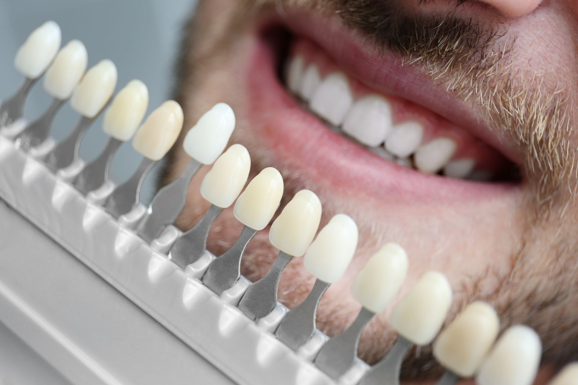 Shade guide with teeth beside a smiling mouth, showing rows of ivory-white color samples
