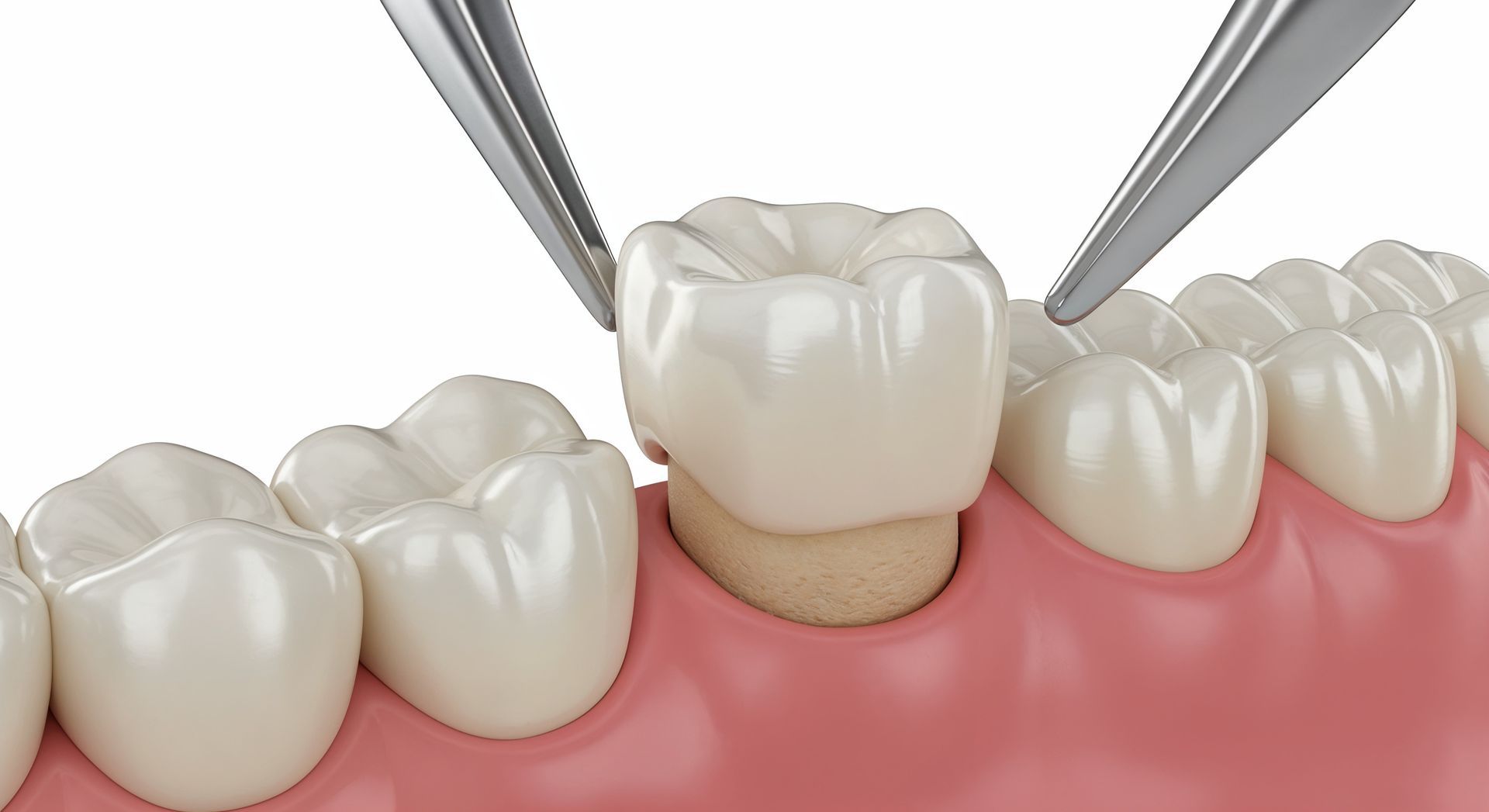 Dental crown being fitted on a tooth with tweezers over pink gums