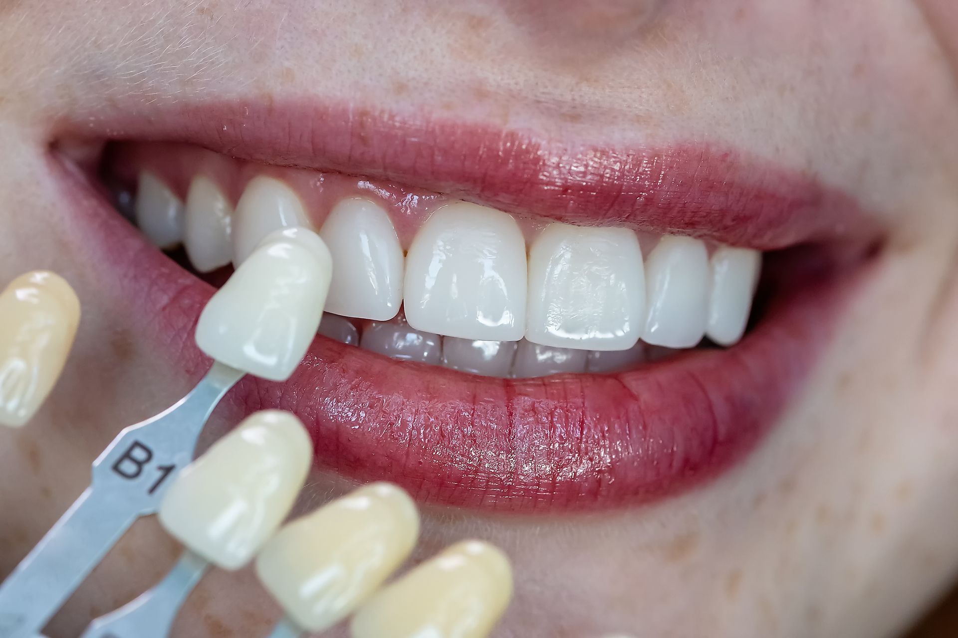 Dental shade guide comparing tooth color to a person's smiling teeth
