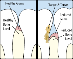 Side-by-side dental diagram comparing healthy gums and plaque buildup with reduced gums and bone level Side-by-side dental diagram comparing healthy gums and plaque buildup with reduced gums and bone level