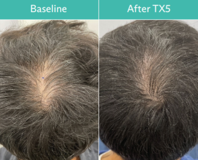 Comparison of a balding scalp before and after TX5 treatment, showing increased hair density.