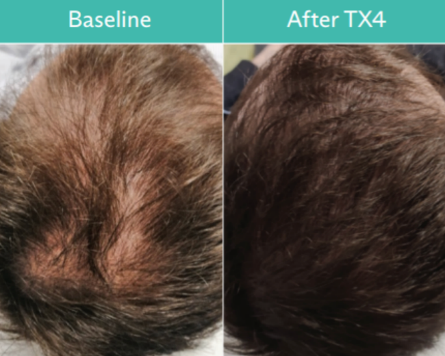 Comparison of thinning hair (