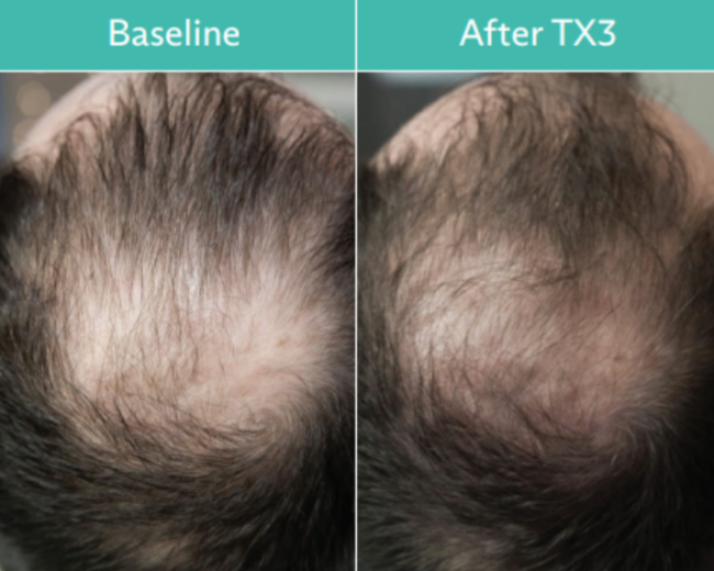 Comparison of scalp with hair loss: Baseline vs. after TX3 treatment, showing some hair regrowth.