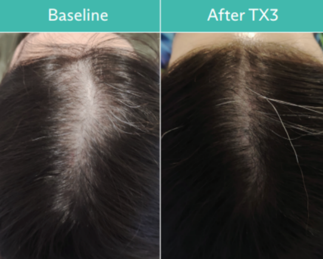 Comparison of a scalp before and after TX3 treatment, showing increased hair density.