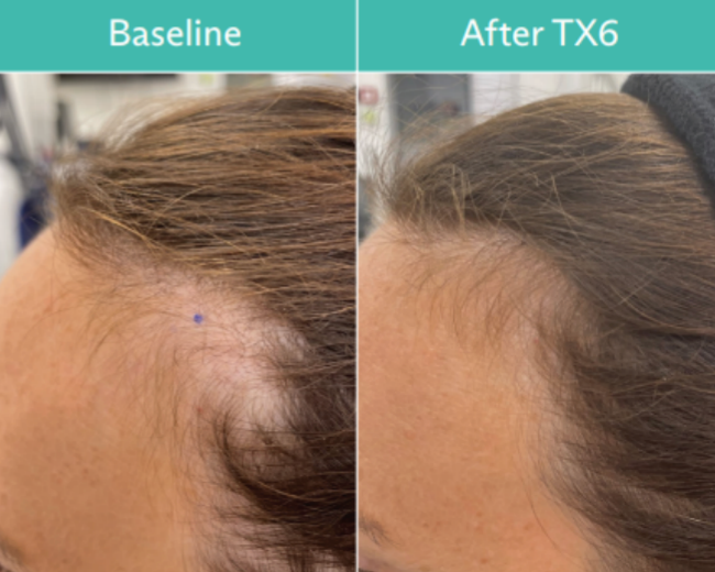 Side-by-side comparison of a person's hairline, showing hair growth after TX6 treatment.