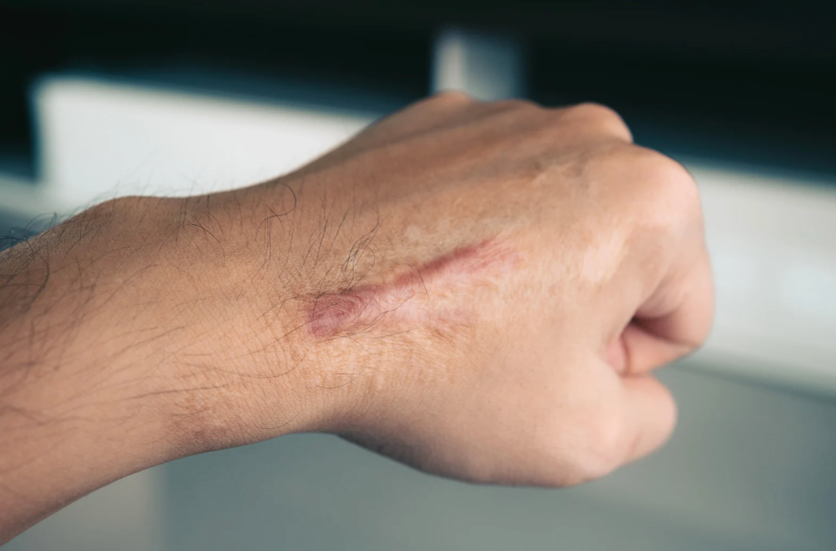 Hand with scar on the back of the wrist, fist clenched.