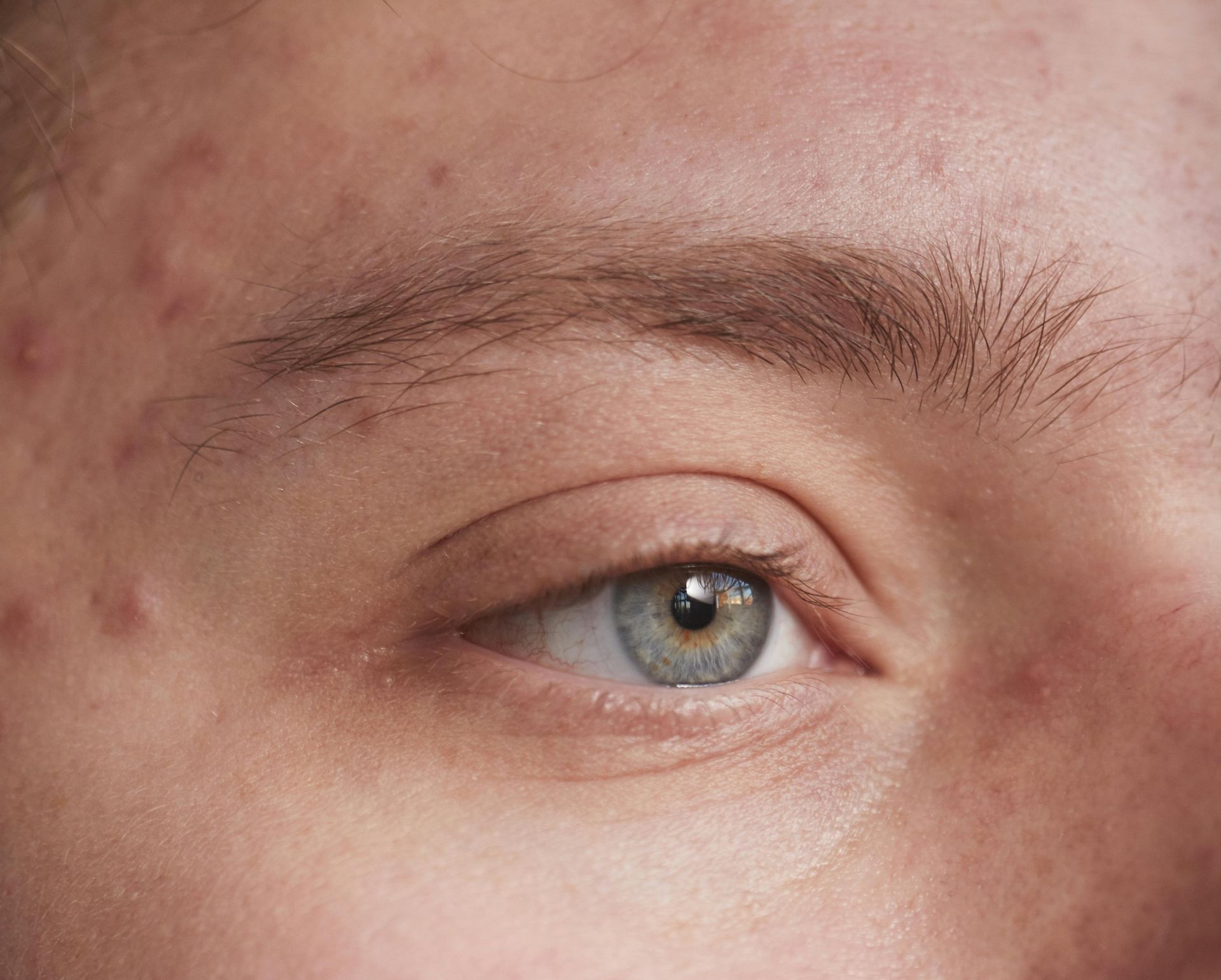 Close-up of a person's eye; blue iris, light skin, visible acne, slightly furrowed brow.