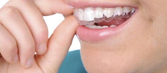 apparecchio denti