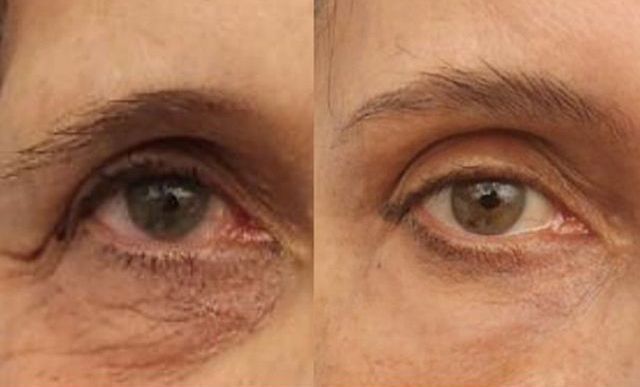 Before and After, Monaco Medspa in Midtown Edgewater Miami, FL, Tear Trough filler, Undereye Filler, lower eyelid filler, Morpheus8 Eyelids , Temple Filler, Plasma Pen To The Eyelids & Eyebrow Botox, Photo of Before and After tear trough filler Hyaluronic Acid Filler, Monaco med spa in Midtown Edgewater Miami, FL