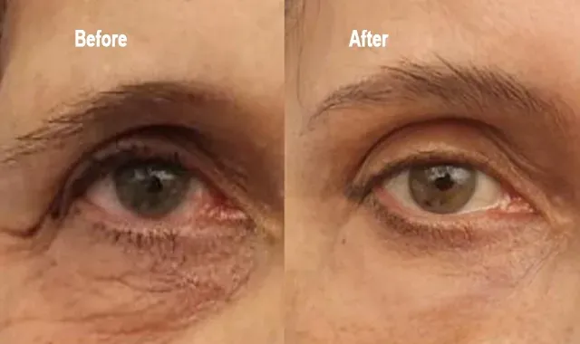 Tear Trough, Before & After, Monaco Medspa, Miami, FL.