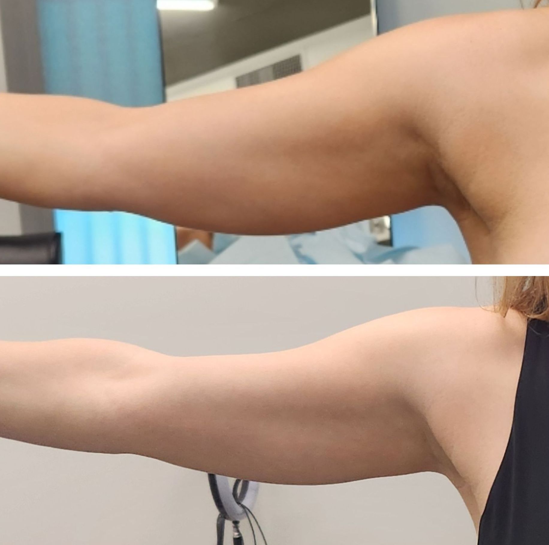 Comparison of a person's arm before and after arm lift procedure, showing reduced skin and improved shape after body countoring and body scultping with a Morpheus8 microneedling with radiofrequency procedure performed by the best cosmetic doctor in Miami, Fl, Dr. Barrueta, at the best med spa in Miami, FL, Monaco MedSpa.