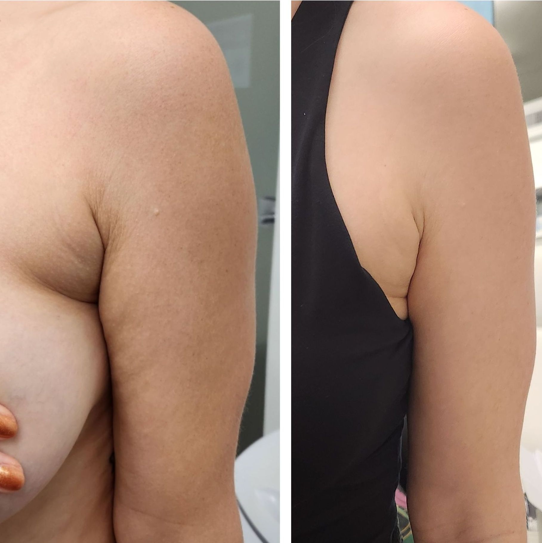Before and after photos of an arm, showing a smoother appearance after body countoring and body scultping with a Morpheus8 microneedling with radiofrequency procedure performed by the best cosmetic doctor in Miami, Fl, Dr. Barrueta, at the best med spa in Miami, FL, Monaco MedSpa.