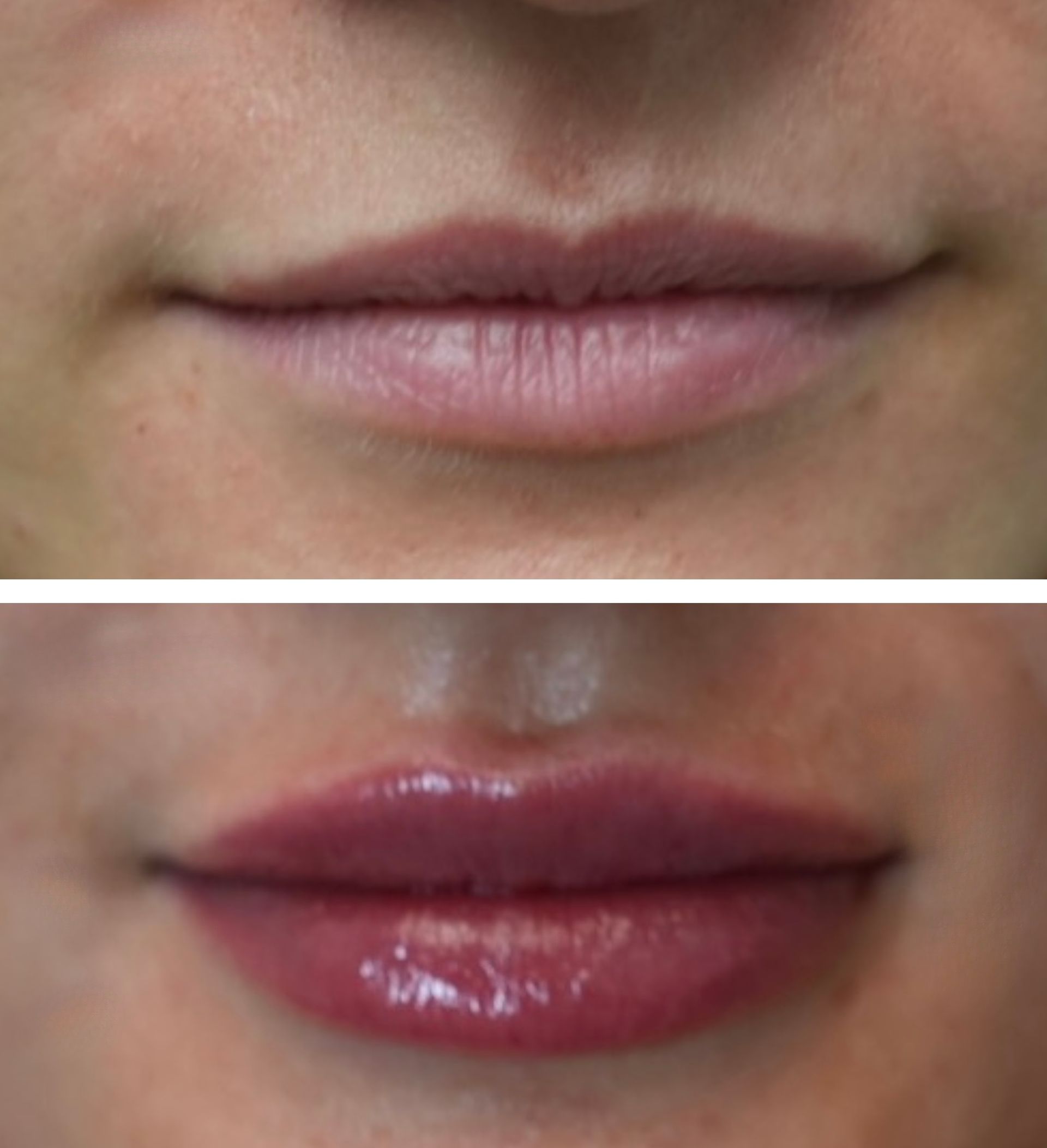 Top: woman's natural lips. Bottom: woman's lips after lip filler; more beautiful, fuller, and glossy after lip filler injections perfomed by the best lip filler injector and cosmetic doctor in Miami, Fl, Dr. Barrueta, at the best med spa in Kendall Miami, FL, Monaco MedSpa..