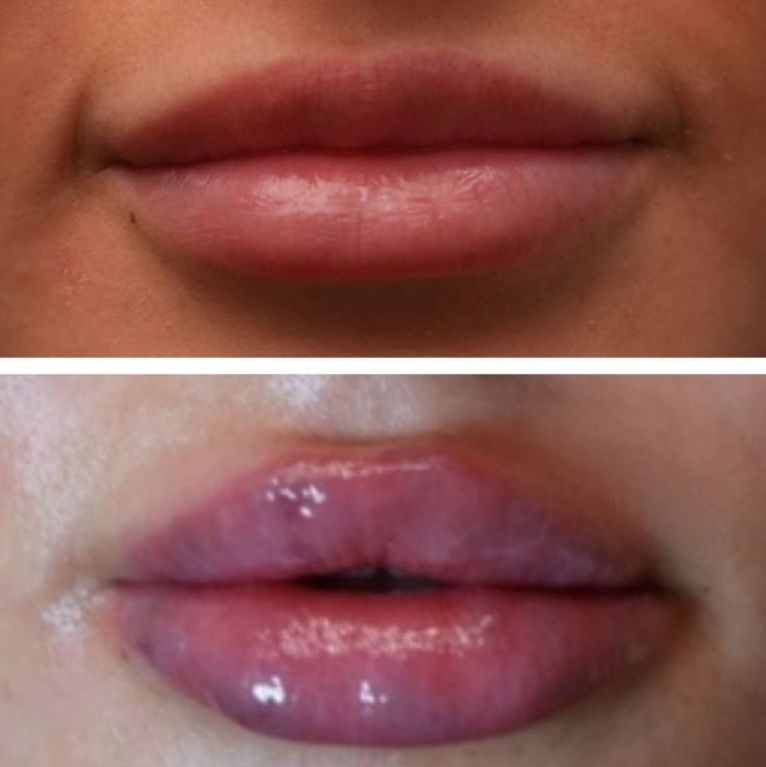 Top: thin lips. Bottom: fuller, shiny, pink lips after lip filler injections perfomed by the best lip filler injector and cosmetic doctor in Miami, Fl, Dr. Barrueta, at the best med spa in Bal Harbor Miami, FL, Monaco MedSpa.