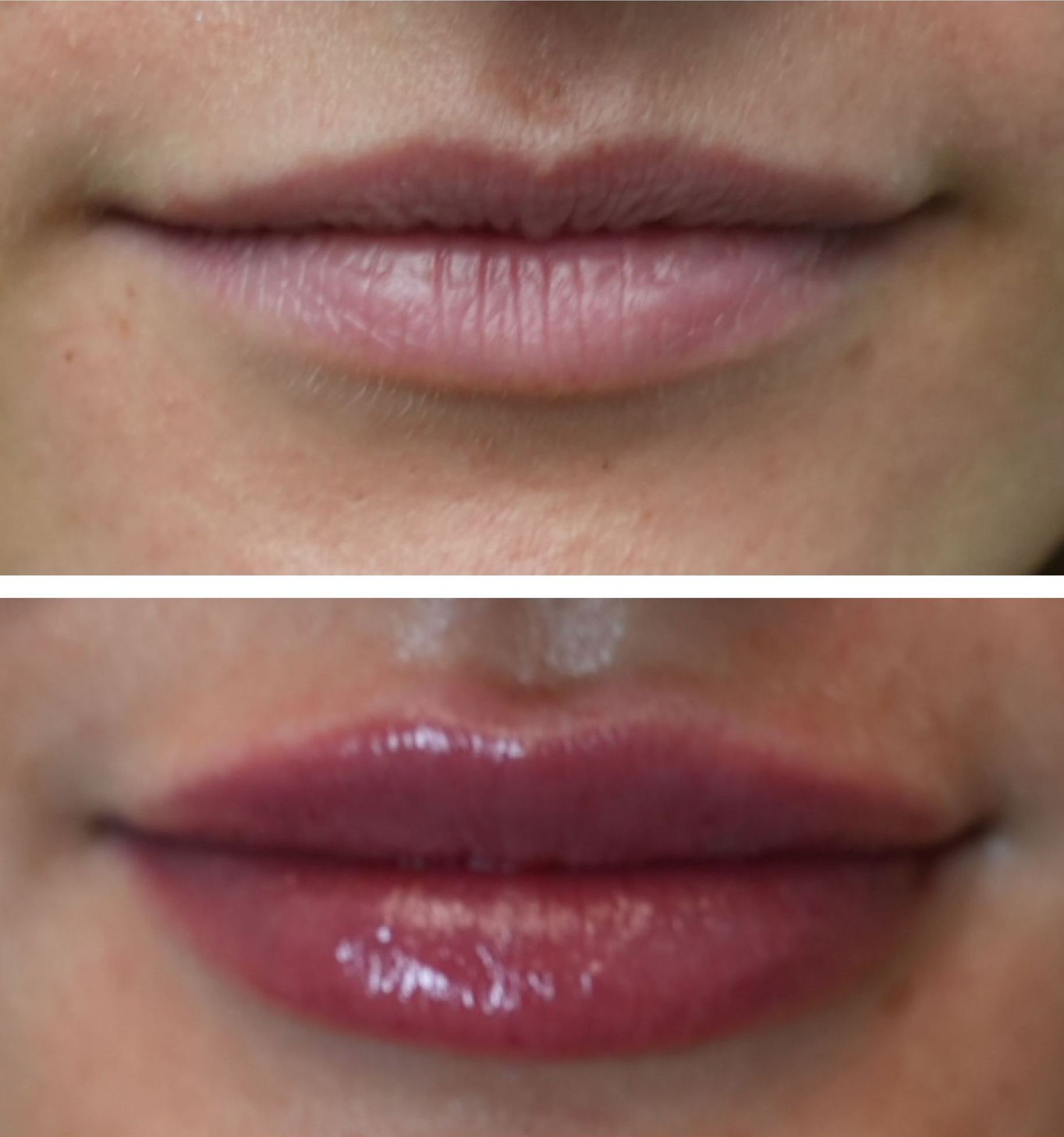 Top: Thin, pale lips. Bottom: Fuller, glossy, deep pink beautiful lips after lip filler injections perfomed by the best lip filler injector and cosmetic doctor in Miami, Fl, Dr. Barrueta, at the best med spa in Brickell Miami, FL, Monaco MedSpa.