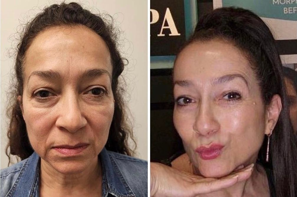 Monaco MedSpa, Miami, FL, Before and After, Midtown miami, Edgewater Miami, FL, Facial Harmonization
Before & 6 Months After
Botox Face, Cheek & Lip Filler, Plasma Pen To The Upper & Lower Eyelids. photo of nonsurgical facelift with Morpheus8 Before and After, in Midtown Miami, Edgewater Miami, FL, microneedling with radiofrequency, at  Monaco med spa in Downtown Worldcenter Miami , Miami Design District, Miami Beach, Bal Harbour, Miami Edgewater Miami Midtown, South Beach, Aventura, Fisher Island, Star Island, FL