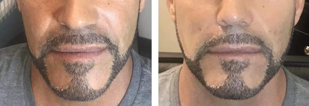Jaw Filler, Cheek Filler, Lip Filler, Monaco MedSpa, Miami, FL, edgewater miami, midtown miami, male botox, male fillers, brotox, jaw contouring, cheek contouring, before and after, radiesse, juvederm, restylane, pdo threads, photo of before and after jaw contouring filler, andpdo threads at Monaco med spa in downtown worldcenter edgewater midtown Miami, FL