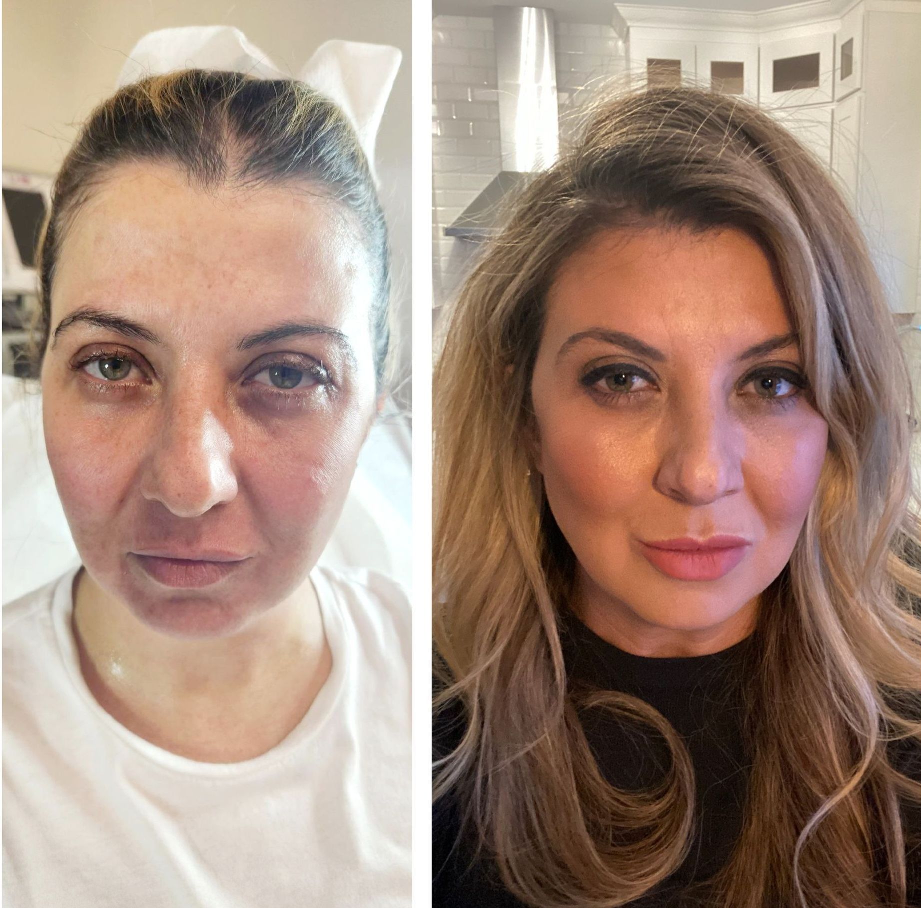 Side-by-side photos of a woman's face before and after a beauty treatment.