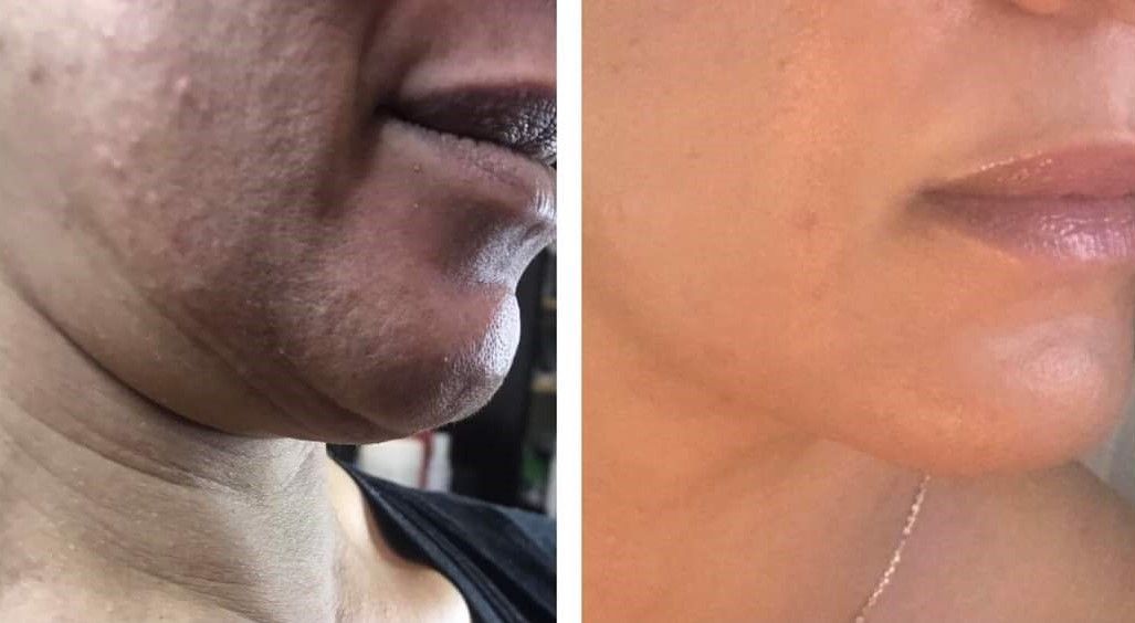 Monaco MedSpa, Miami, FL, Before and After, Midtown miami, Edgewater Miami, FL, Facial Harmonization
Before & 8 Weeks After
Pic Sent By Client
Morpheus8 Face & Neck
Cheek Filler
Facial Botox
Neck Botox
Skin Care Creams for Acne, Melasma, Rosacea, & Bleaching Cream Monaco med spa in downtown worldcenter edgewater midtown Miami, FL, photo of nonsurgical facelift with Morpheus8 Before and After, in Midtown Miami, Edgewater Miami, FL, microneedling with radiofrequency, at Monaco med spa in Downtown Worldcenter Miami , Miami Design District, Miami Beach, Bal Harbour, Miami Edgewater Miami Midtown, South Beach, Aventura, Fisher Island, Star Island, FL, Medical grade skincare, skin care