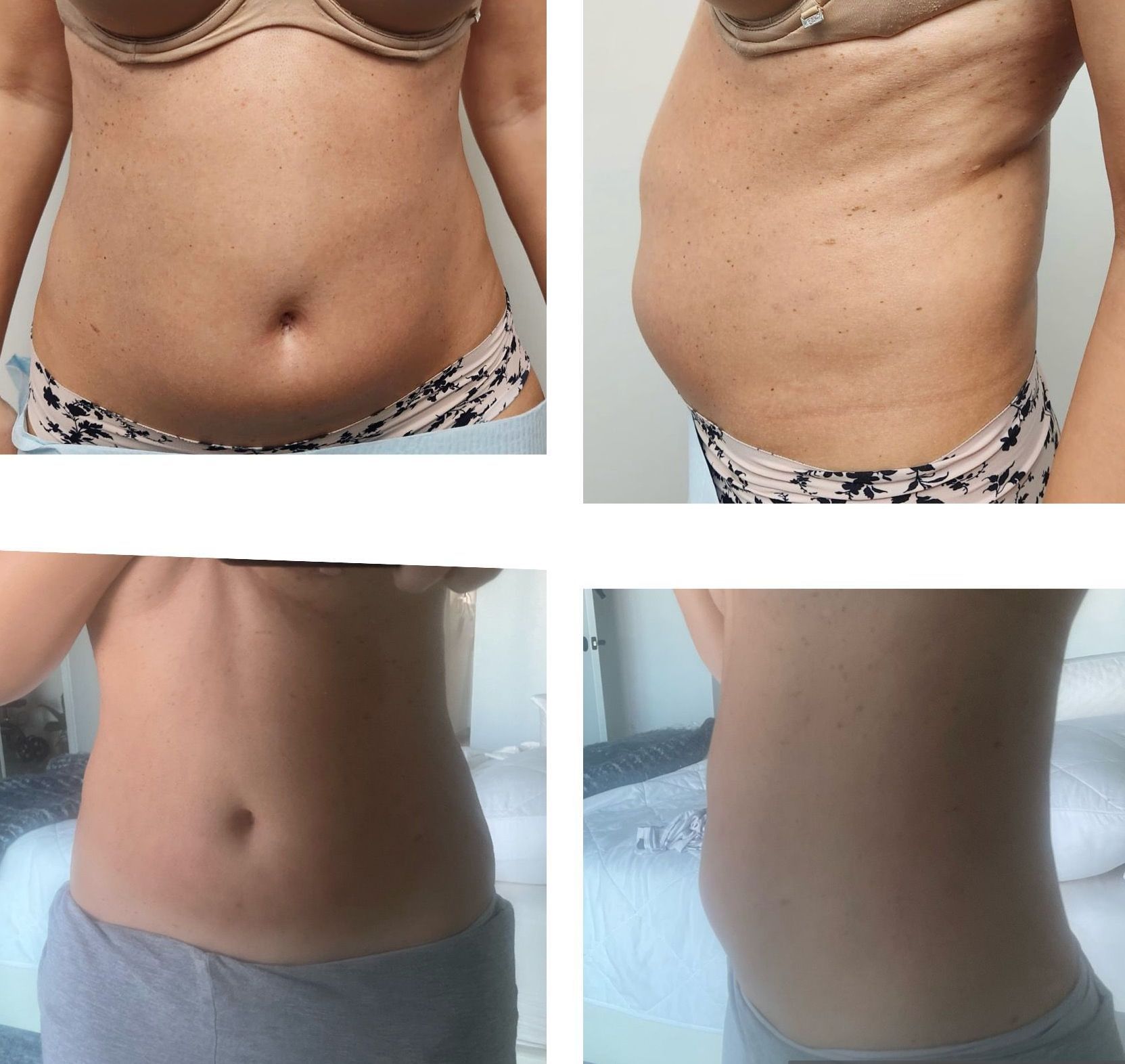 Abdomen before and after, showing reduction in fat after treatment after body countoring and body scultping with a Morpheus8 microneedling with radiofrequency procedure performed by the best cosmetic doctor in Miami, Fl, Dr. Barrueta, at the best med spa in Miami, FL, Monaco MedSpa.