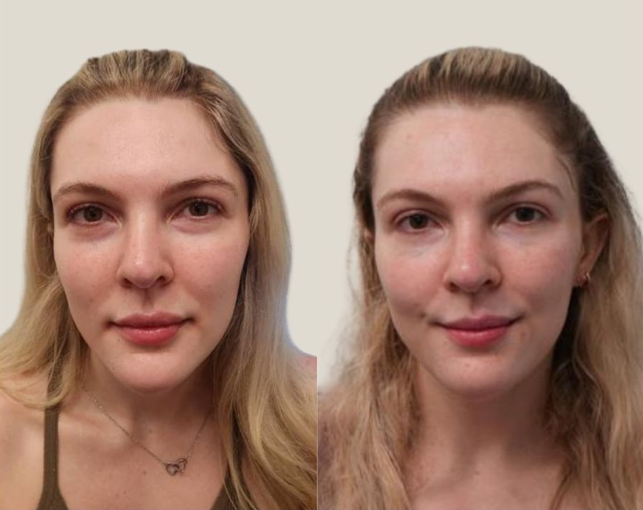 Image of a female face
Before and 3 Months After Hyaluronic Acid HA Fillers including Jaw Contouring Filler, Lower Eyelid & Tear Trough Filler, Cheek Filler, Periauricular Biostimulating Filler, Temple Fillerand DAO Botox by Dr. Barrueta the best cosmetic doctor injector in Miami, FL at the best med spa in Miami, Monaco MedSpa