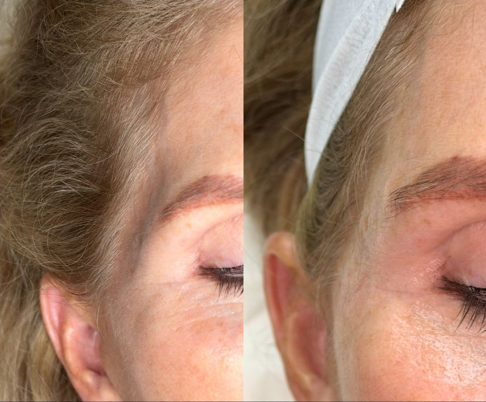 Photo of a client Before and Immediately After Temple filler performed by the best cosmetic surgeon in Miami, FL at the best med spa in Miami, Monaco MedSpa
