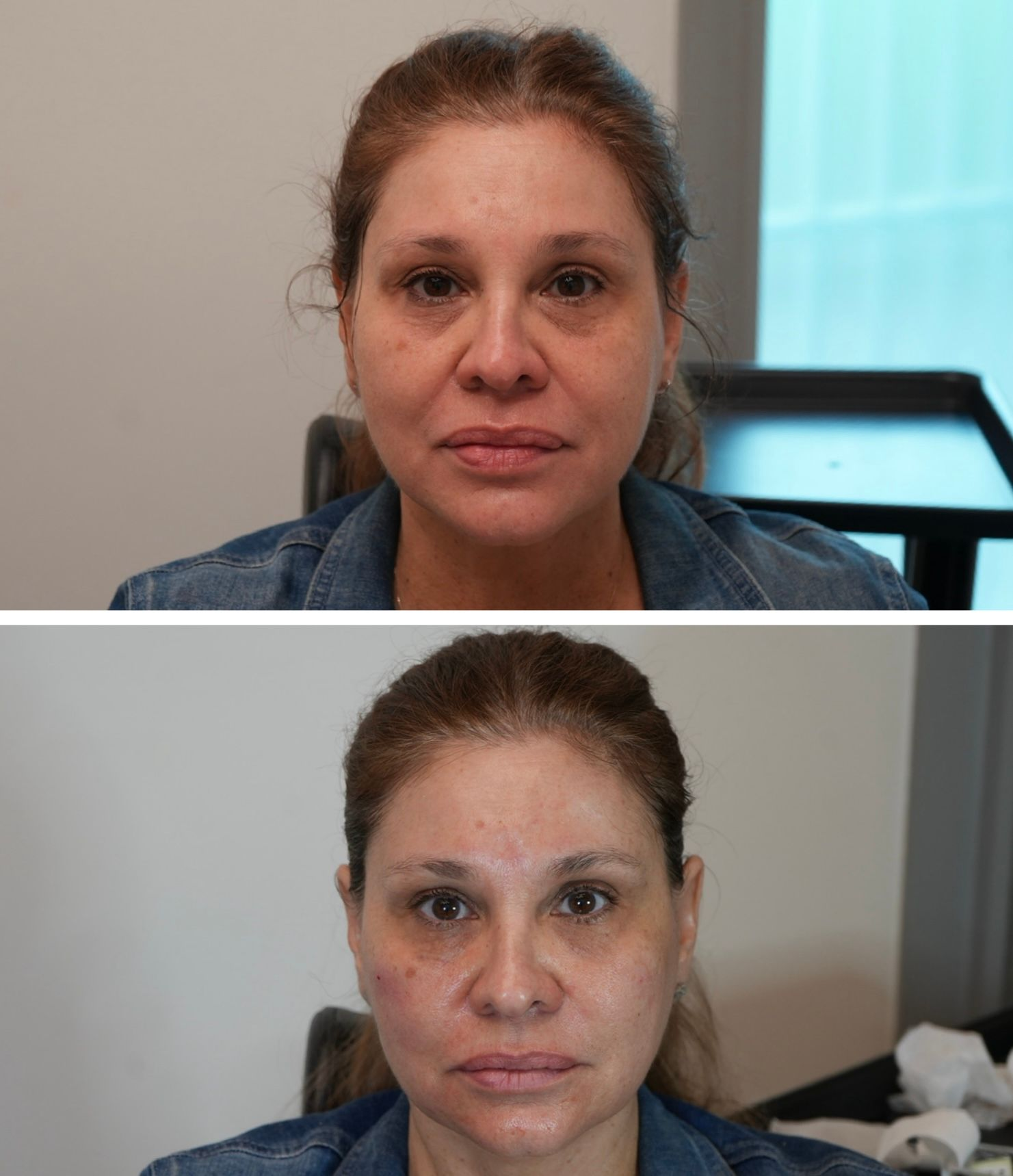 Photo of a client Before and Immediately After Nasolabial filler, tear trough under eye filler and Zygoma cheekFiller performed by the best cosmetic doctor in Miami, FL at the best med spa in Miami, Monaco MedSpa