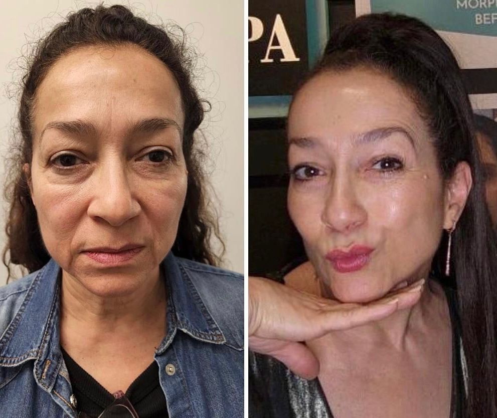 morpheus8, Before and After, Monaco Medspa in Midtown Edgewater Miami, FL, Before & 6 Months After, Botox Face, Cheek filler, Lip Filler, Plasma Pen To The Upper & Lower Eyelids, Morpheus8 Face, morpheus8 Eyelids, morpheus8 Neck, Photo of Before and After Botox, Filler, Monaco med spa in Midtown Edgewater Miami, FL