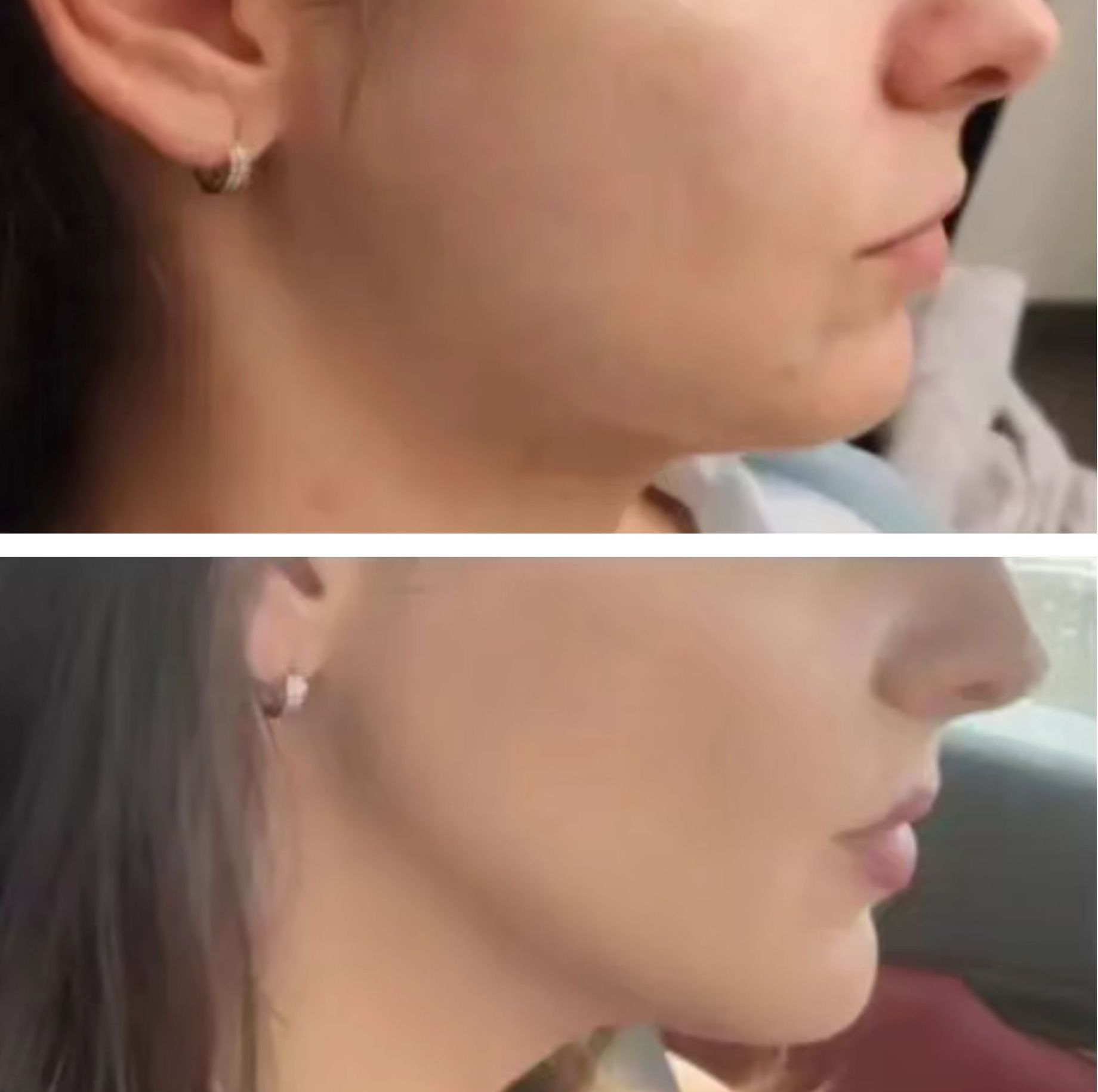 photo of Jaw Contouring
Before and 2 Days After Jaw Contouring Radiesse Filler by DR. barrueta the best filler injector doctor in Miami Fl at the best med spa in Miami Fl Monaco MedSpa