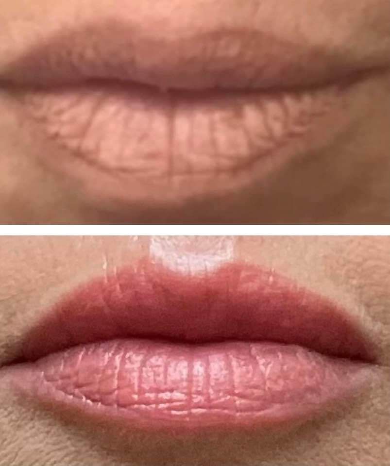 Top: dry, cracked lips. Bottom: plump, moisturized beautiful lips, pinkish hue after lip filler injections perfomed by the best lip filler injector and cosmetic doctor in Miami, Fl, Dr. Barrueta, at the best med spa in Miami, FL, Monaco MedSpa.