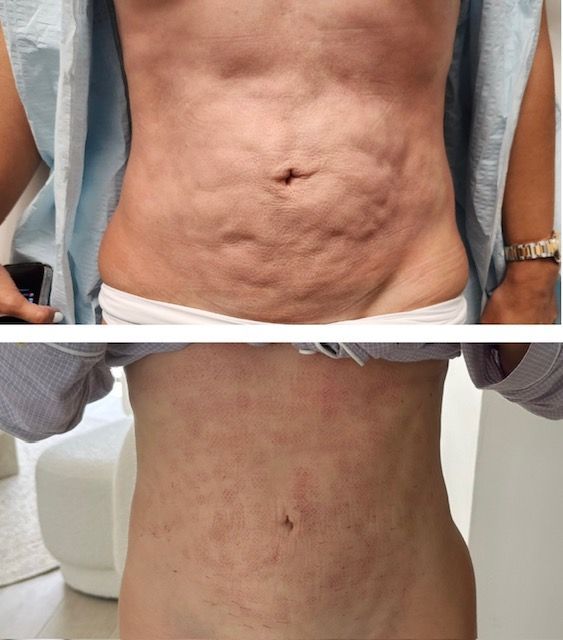 Before and after comparison of a person's abdomen, showing reduced cellulite after treatment after body countoring and body scultping with a Morpheus8 microneedling with radiofrequency procedure performed by the best cosmetic doctor in Miami, Fl, Dr. Barrueta, at the best med spa in Miami, FL, Monaco MedSpa.