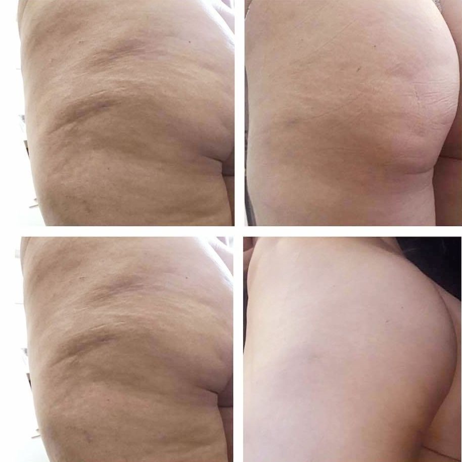 Before-and-after cellulite reduction on a person's buttocks and thighs, showing a smoother skin appearance after body countoring and body scultping with a Morpheus8 microneedling with radiofrequency procedure performed by the best cosmetic doctor in Miami, Fl, Dr. Barrueta, at the best med spa in Miami, FL, Monaco MedSpa.