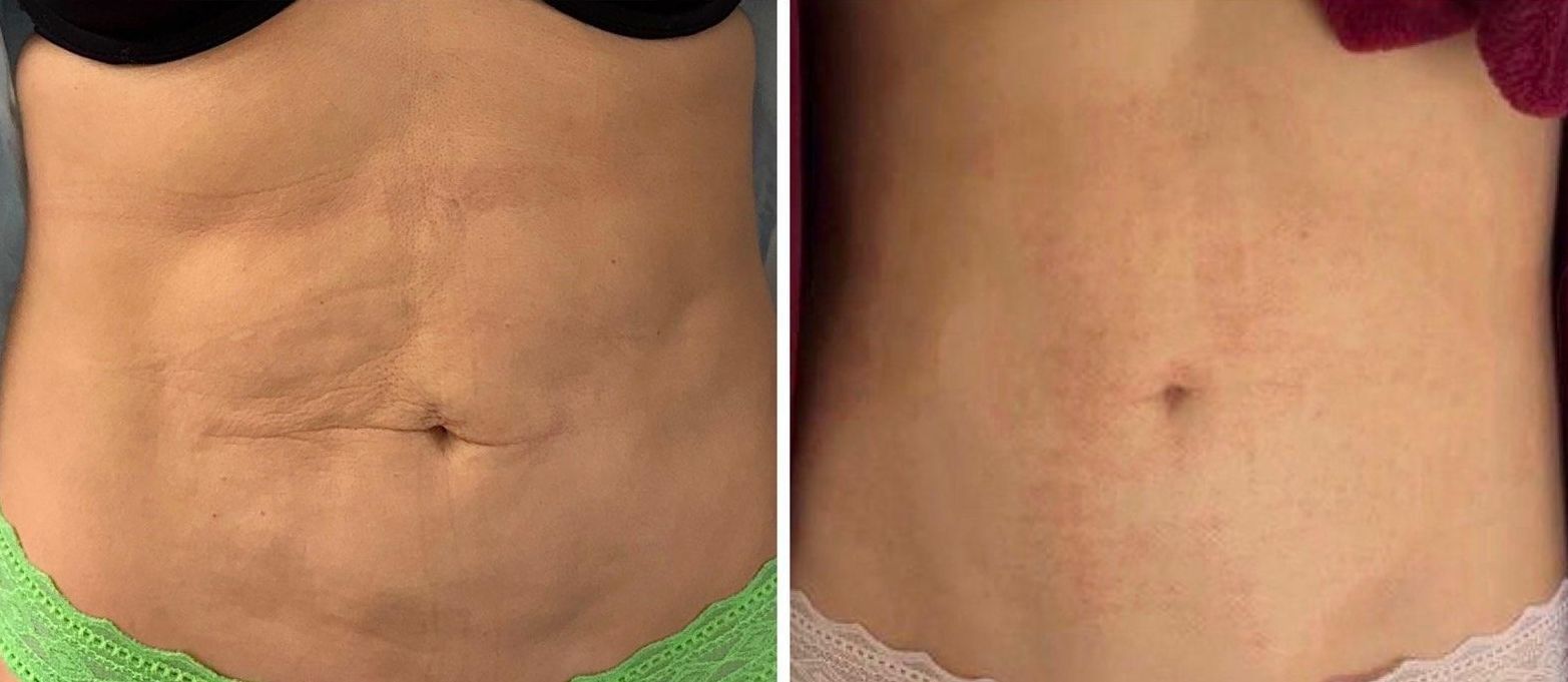 Side-by-side of a torso before and after a treatment, showing a reduction in stretch marks and smoother skin after body countoring and body scultping with a Morpheus8 microneedling with radiofrequency procedure performed by the best cosmetic doctor in Miami, Fl, Dr. Barrueta, at the best med spa in Miami, FL, Monaco MedSpa..