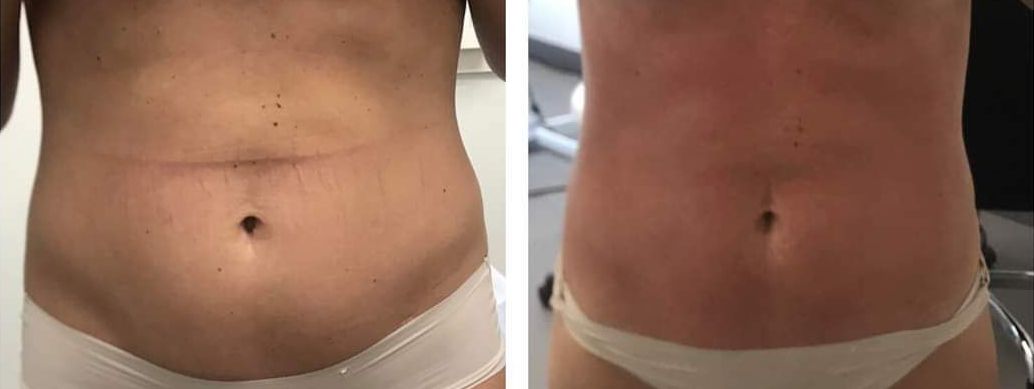 Before and after images of a person's midriff, possibly after a cosmetic procedure; after body countoring and body scultping with a Morpheus8 microneedling with radiofrequency procedure performed by the best cosmetic doctor in Miami, Fl, Dr. Barrueta, at the best med spa in Miami, FL, Monaco MedSpa.