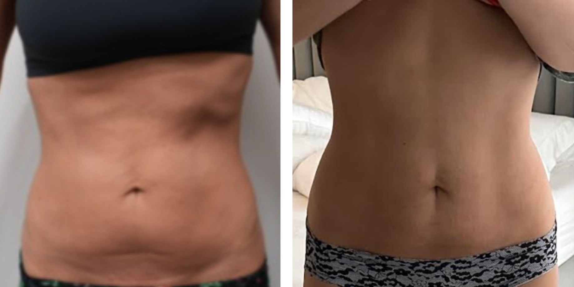 Side-by-side comparison of a person's midsection abdomen and stomach before and after a procedure; showing a reduction in visible lines and fat after body countoring and body scultping with a Morpheus8 microneedling with radiofrequency procedure performed by the best cosmetic doctor in Miami, Fl, Dr. Barrueta, at the best med spa in Miami, FL, Monaco MedSpa.